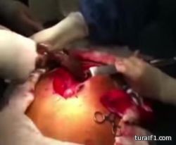 استخراج سمكة حية بطول 1 متر من أمعاء رجل برازيلى