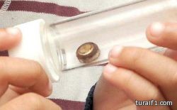 طفل يعيش ببطارية في أنفه بسبب خطأ تشخيص الأطباء لحالته